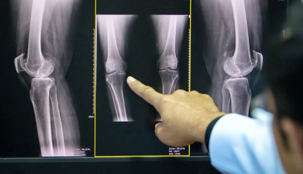 knee x-ray joints