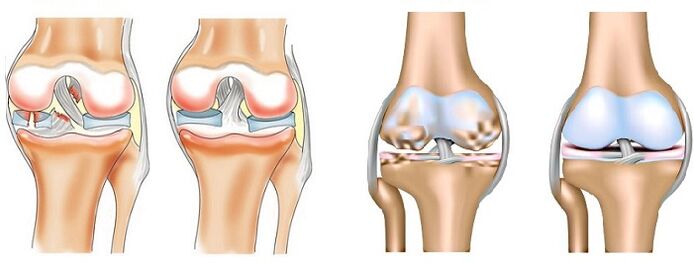 Difference between arthritis (left) and arthritis (right) of the joints