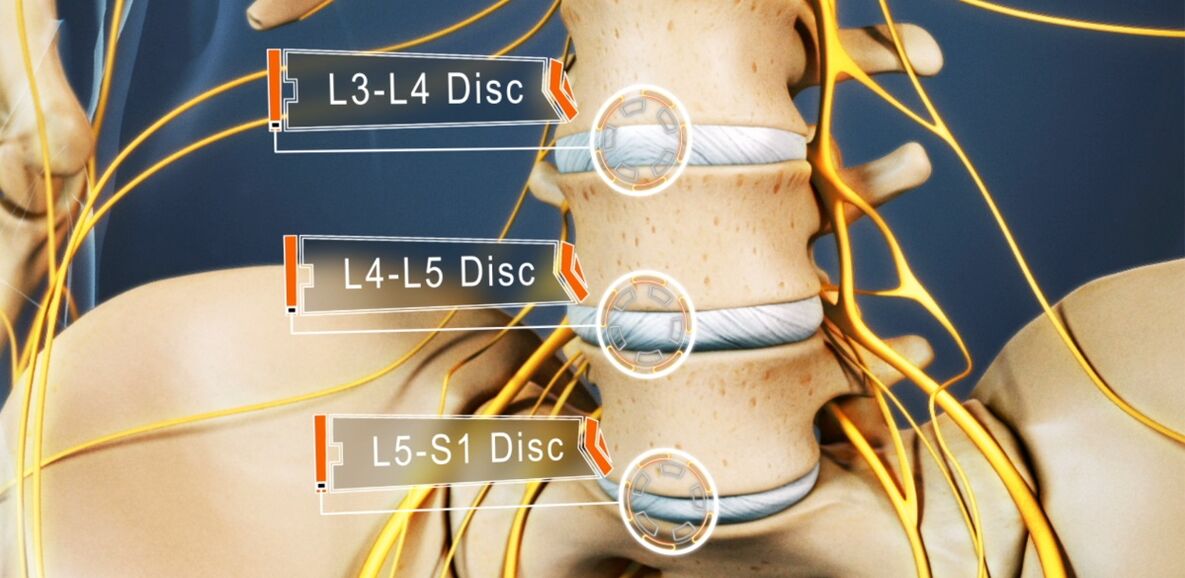 Lumbar discs of the spine, most commonly affected in osteochondrosis