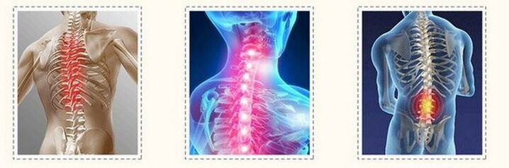 osteochondria of different spine