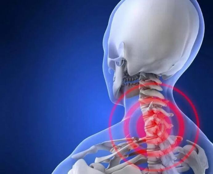 What is osteochondria