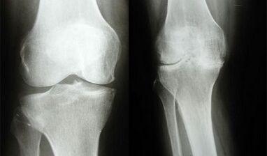 Knee diagnosis methods