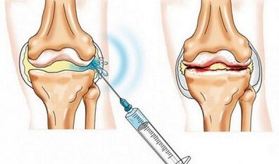 The blocking of the knee joint for arthritis