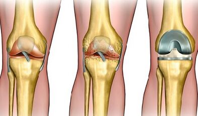 The degree of development of the articulation of the knee joint
