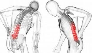 Intervertebral Hernia - Osteochondria