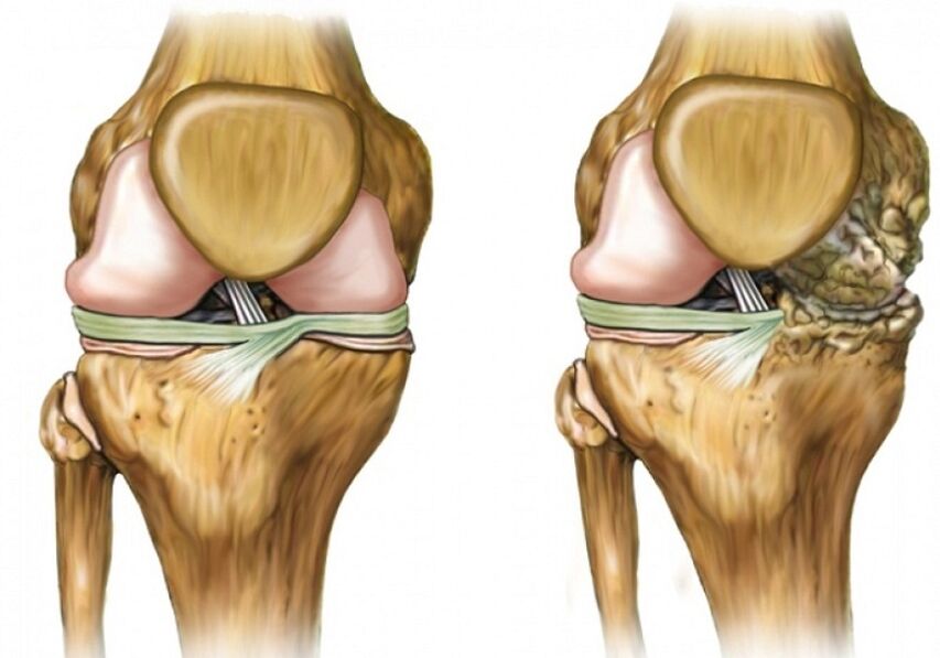 Knee articulation