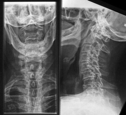 Cervical X -Ray - method of diagnosis of osteochondicity