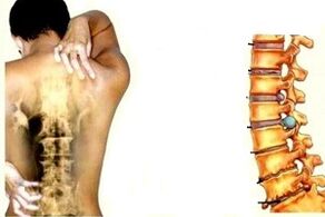 Back pain at different stages of cervical osteochondicity development