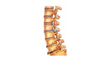 Damage to the spine with cervical osteochondria