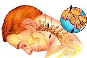 Nerve sting in the spine with cervical osteochondria
