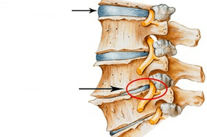 normal and damaged spine with cervical osteochondria