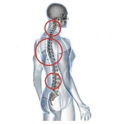 sites of vertebral osteochondrosis