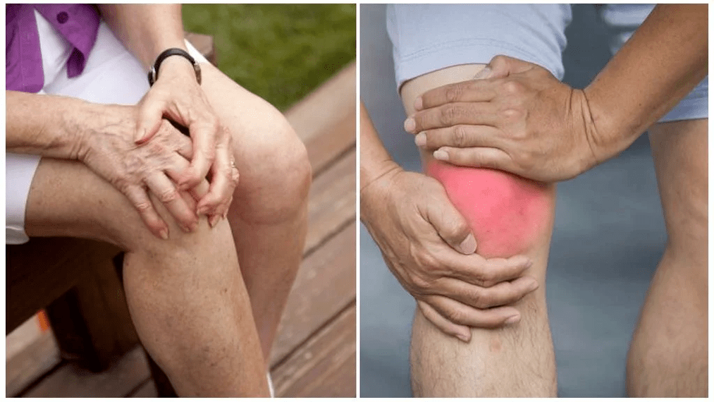 arthritis treatment