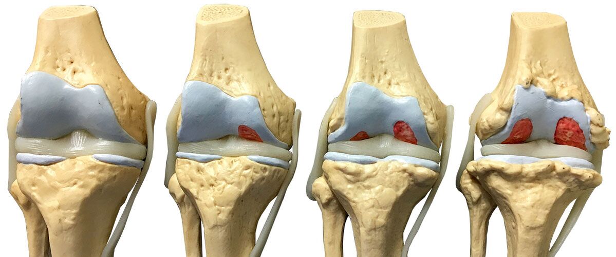 stages of arthritis