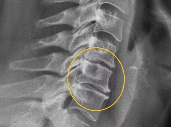 Osteochondrosis of the cervical spine on radiograph